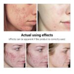 BREYLEE Acne Treatment Serum Face Facial Anti Acne Scar Removal Cream Skin Care Whitening Repair Pimple Remover For Acne - Image 4
